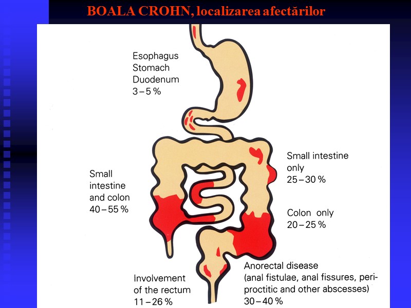 BOALA CROHN, localizarea afectărilor